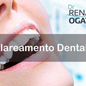 Clareamento Dental em Sinop