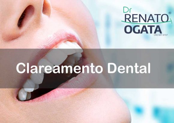 Clareamento Dental em Sinop