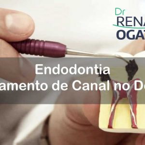 Endodontia (Tratamento de Canal no Dente) em Sinop