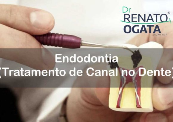 Endodontia (Tratamento de Canal no Dente) em Sinop