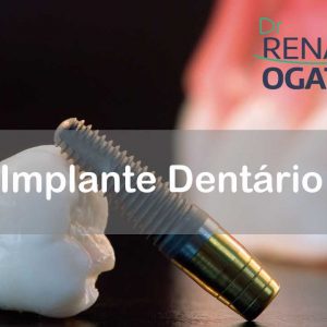 Implantes Dentários em Sinop