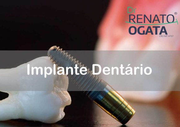 Implantes Dentários em Sinop